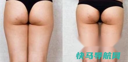 吸脂去脂肪会反弹吗 第2张
