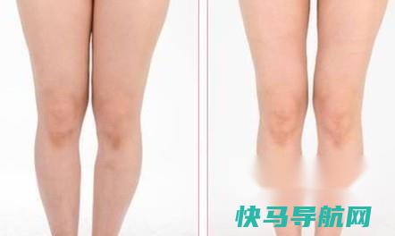吸脂去脂肪会反弹吗 第5张